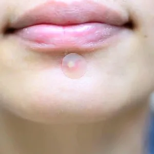 Magic Skin Patch to Remove Skin Tags, Pimples, Blackheads